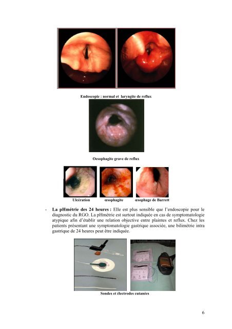 Le reflux gastro-Åsophagien