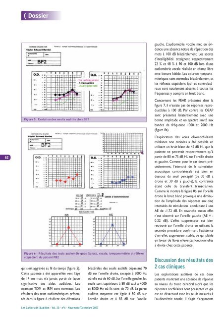 la neuropathie auditive / dÃ©synchronisation auditive - CollÃ¨ge ...