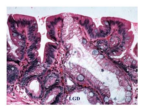 Biomarkers of High Grade Dysplasia in Barrett's Esophagus