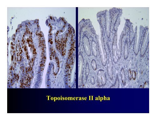 Biomarkers of High Grade Dysplasia in Barrett's Esophagus