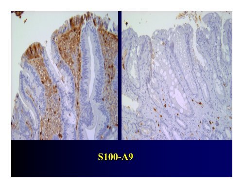 Biomarkers of High Grade Dysplasia in Barrett's Esophagus