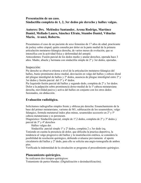 Sindactilia completa de 1, 2, 3er dedos pie derecho y hallux valgus