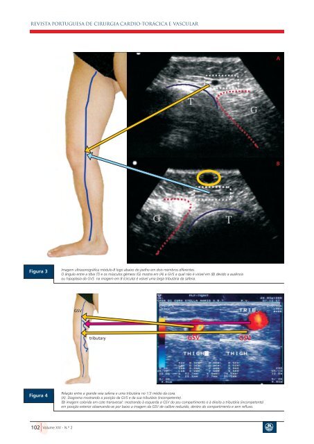 Resumo Summary - Sociedade Portuguesa de Cirurgia Cardio ...