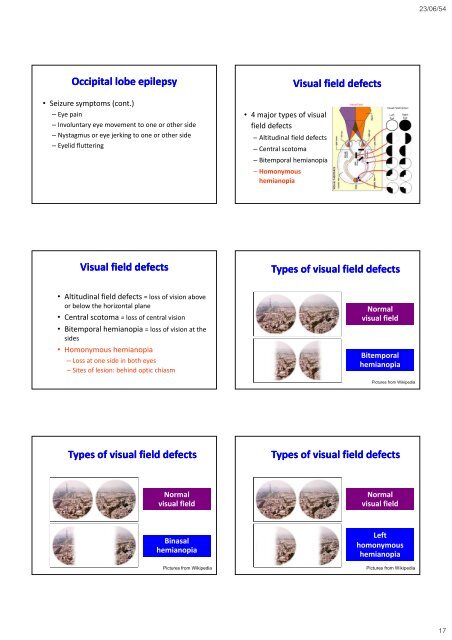 The occipital The occipital lobes Occipital lobe - Mahidol University