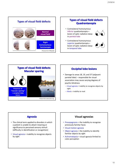 The occipital The occipital lobes Occipital lobe - Mahidol University