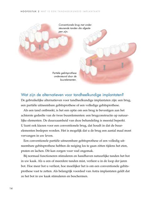 Wat kunnen tandheelkundige implantaten voor u ... - Astra Tech