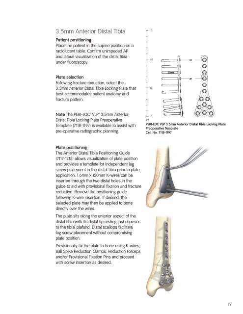 PeriLoc VLP Technique.pdf - Bonerepmedical.com