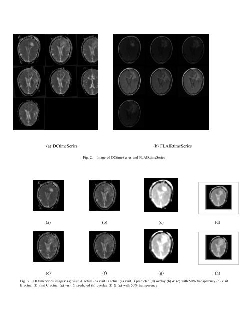 Brain Tumor Growth Analysis Using a Dimensionality Reduction ...