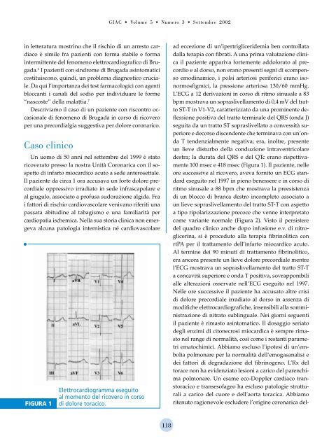 âFenomenoâ di Brugada intermittente - Giornale Italiano di ...