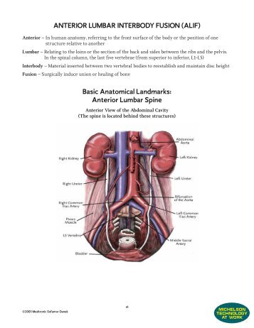 ANTERIOR LUMBAR INTERBODY FUSION (ALIF) Basic Anatomical ...