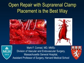 Open Repair with Suprarenal Clamp Placement is ... - VascularWeb