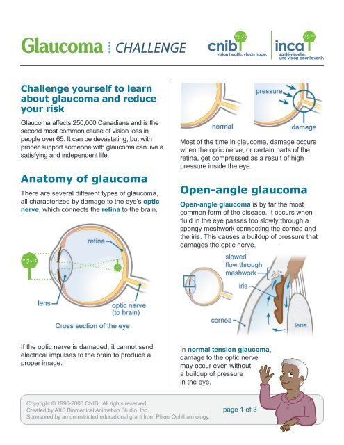 Anatomy of glaucoma Open-angle glaucoma - CNIB