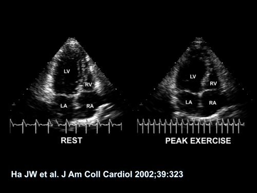 Arterial Stiffness and Cardiovascular Diseases