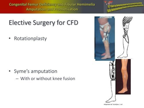 Congenital Femur Deficiency and Fibular Hemimelia â Amputation ...