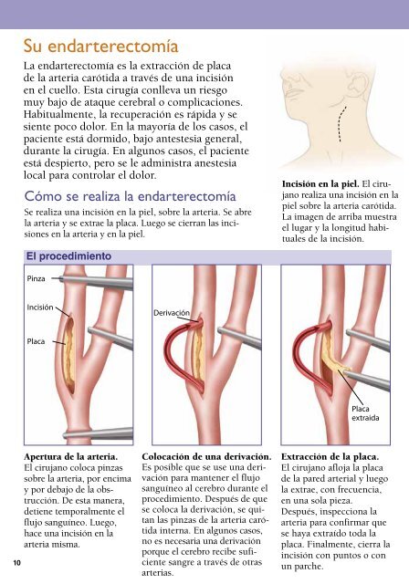 Endarterectomía carótida - Veterans Health Library