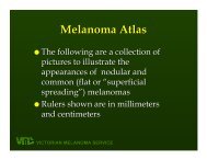 Brief information on nodular melanomas - pictures