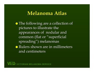 Brief information on nodular melanomas - pictures