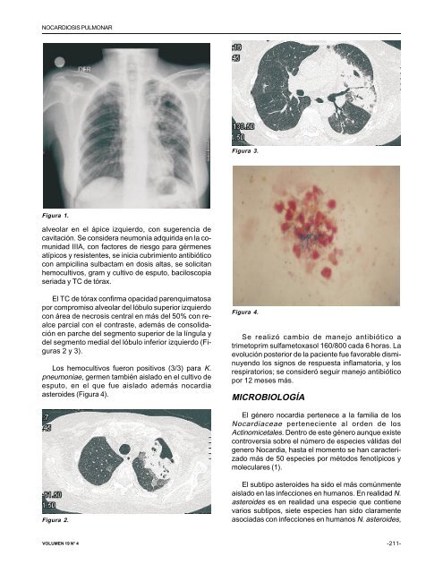 Nocardiosis pulmonar, - Asoneumocito