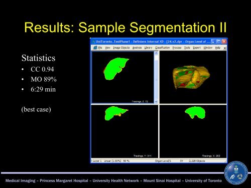 Automated CT Based Liver Volume Assessment - Definiens