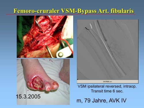 (pAVK) und Diabetes mellitus