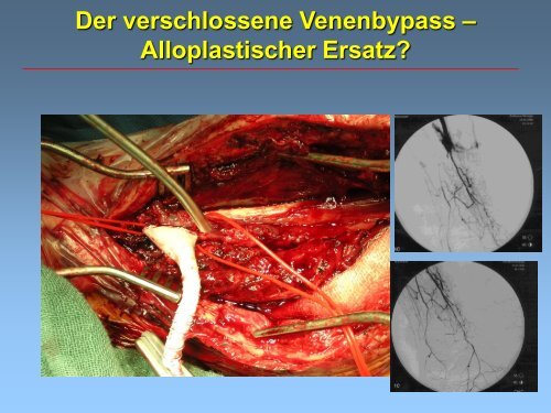 (pAVK) und Diabetes mellitus