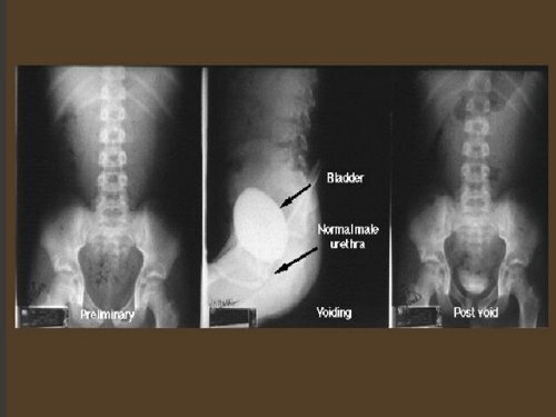 Pediatric urinary tract infection