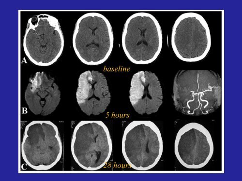 decompressive hemicraniectomy for malignant mca ... - RM Solutions