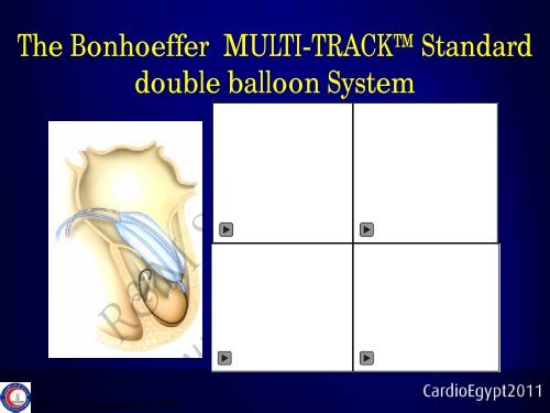 Balloon mitral valvuloplasty in patients with ... - cardioegypt2011