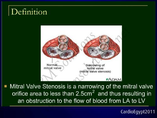 Balloon mitral valvuloplasty in patients with ... - cardioegypt2011