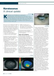 Keratoconus A clinical update - David Thomas Contact Lenses