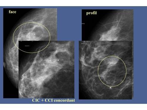 Evaluation des macrobiopsies stÃ©rÃ©otaxiques en 8-Gauge dans les ...