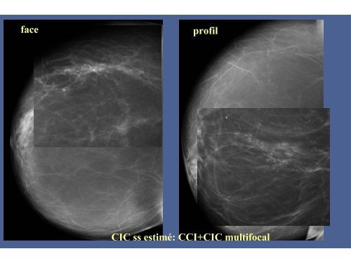 Evaluation des macrobiopsies stÃ©rÃ©otaxiques en 8-Gauge dans les ...