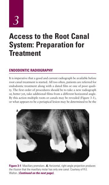 Ch03: ACCESS TO THE ROOT CANAL SYSTEM: PREPARATION ...
