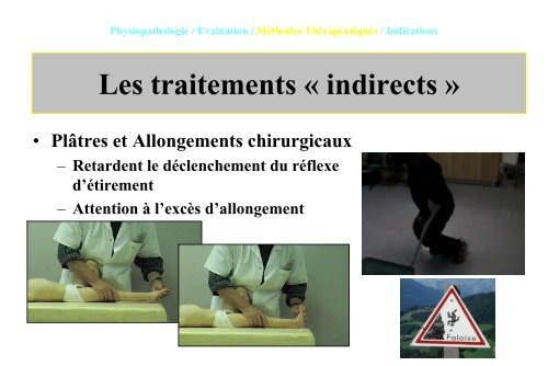 Le traitement de la spasticitÃ© chez l'enfant Infirme Moteur ... - SOFOP