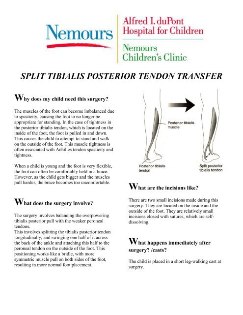 Split Tibialis Posterior Tendon Transfer