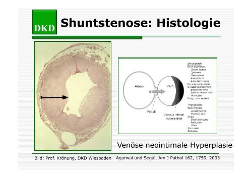 Strutz - Shuntstenose [Compatibility Mode] - Berliner DialyseSeminar