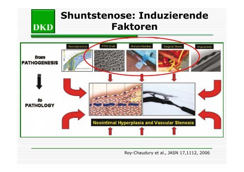 Strutz - Shuntstenose [Compatibility Mode] - Berliner DialyseSeminar