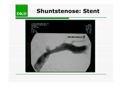Strutz - Shuntstenose [Compatibility Mode] - Berliner DialyseSeminar