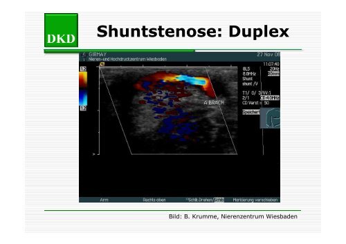 Strutz - Shuntstenose [Compatibility Mode] - Berliner DialyseSeminar