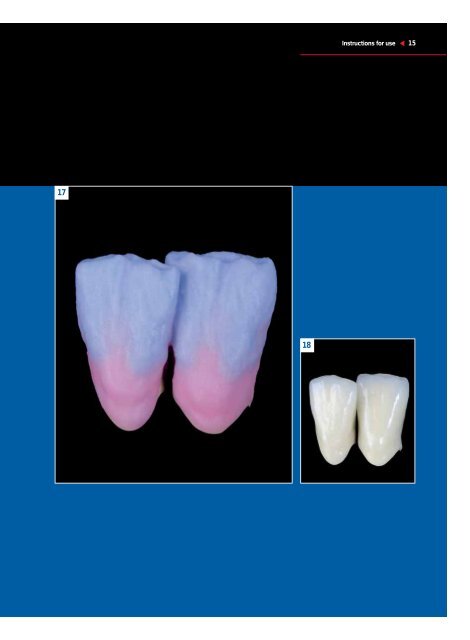 Cercon ceram kiss - DENTSPLY Prosthetics