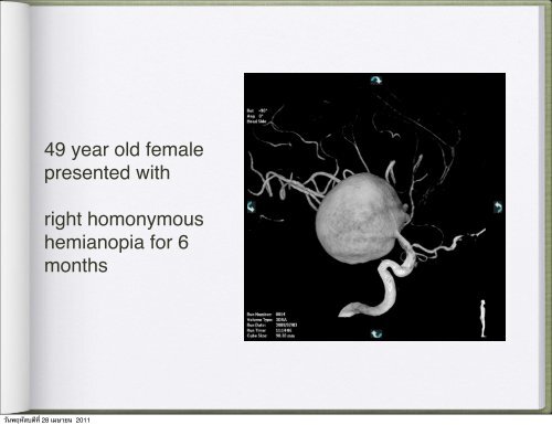 Thaweesak Aurboonyawat, MD, M.Sc. - Neuroscience.mahidol.ac.th ...