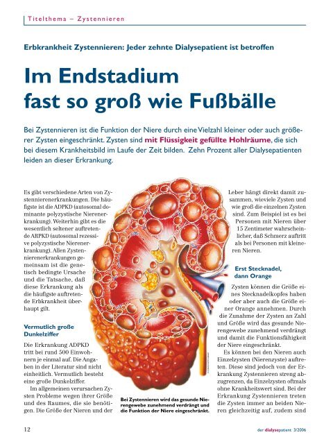 Im Endstadium Fast So Gross Wie Fussballe Pkd Familiare