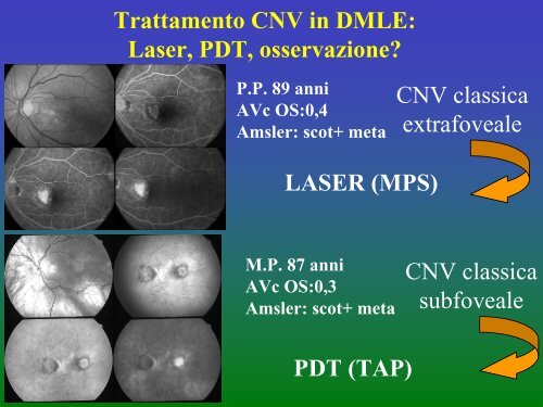 Classificazione della CNV e attuali possibilitÃ  ... - ABCsalute.it