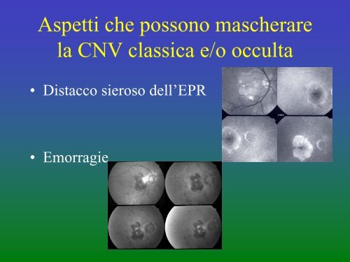 Classificazione della CNV e attuali possibilitÃ  ... - ABCsalute.it