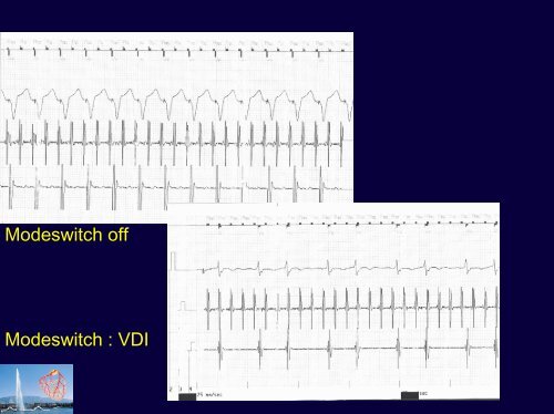 Syndrome du pacemaker