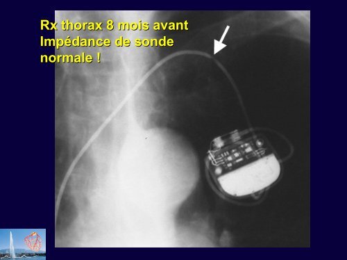 Syndrome du pacemaker