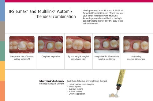 e.max - Keating Dental Lab