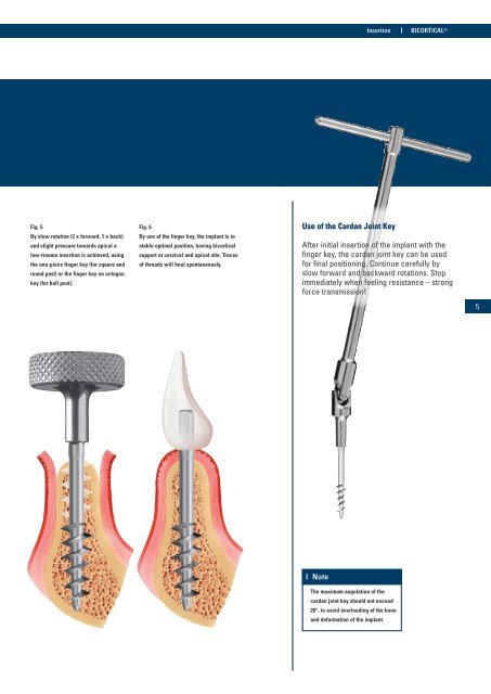 The Bicortical Implant for immediate insertion after ... - Implant Direct