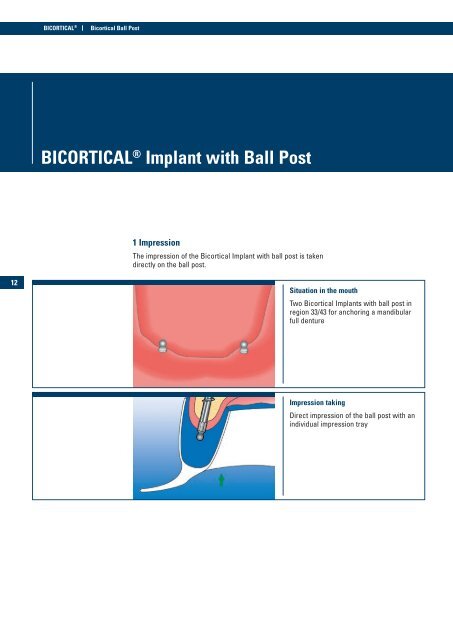 BICORTICAL® Implant with Ball Post - Implant Direct