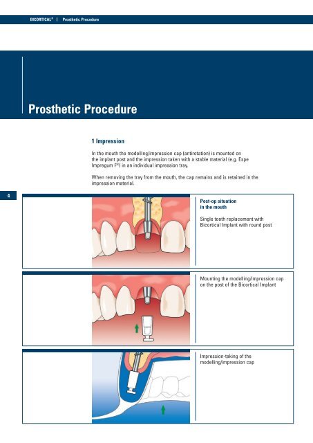 BICORTICAL® Implant with Ball Post - Implant Direct